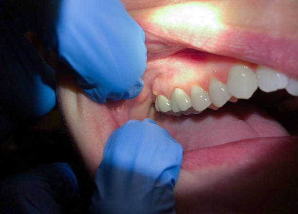 Best Emergency Root Canal Treatment in Bourbon, MO