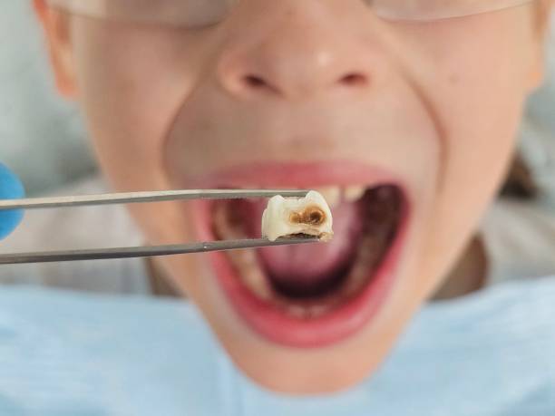 Best Emergency Tooth Extraction in Bourbon, MO